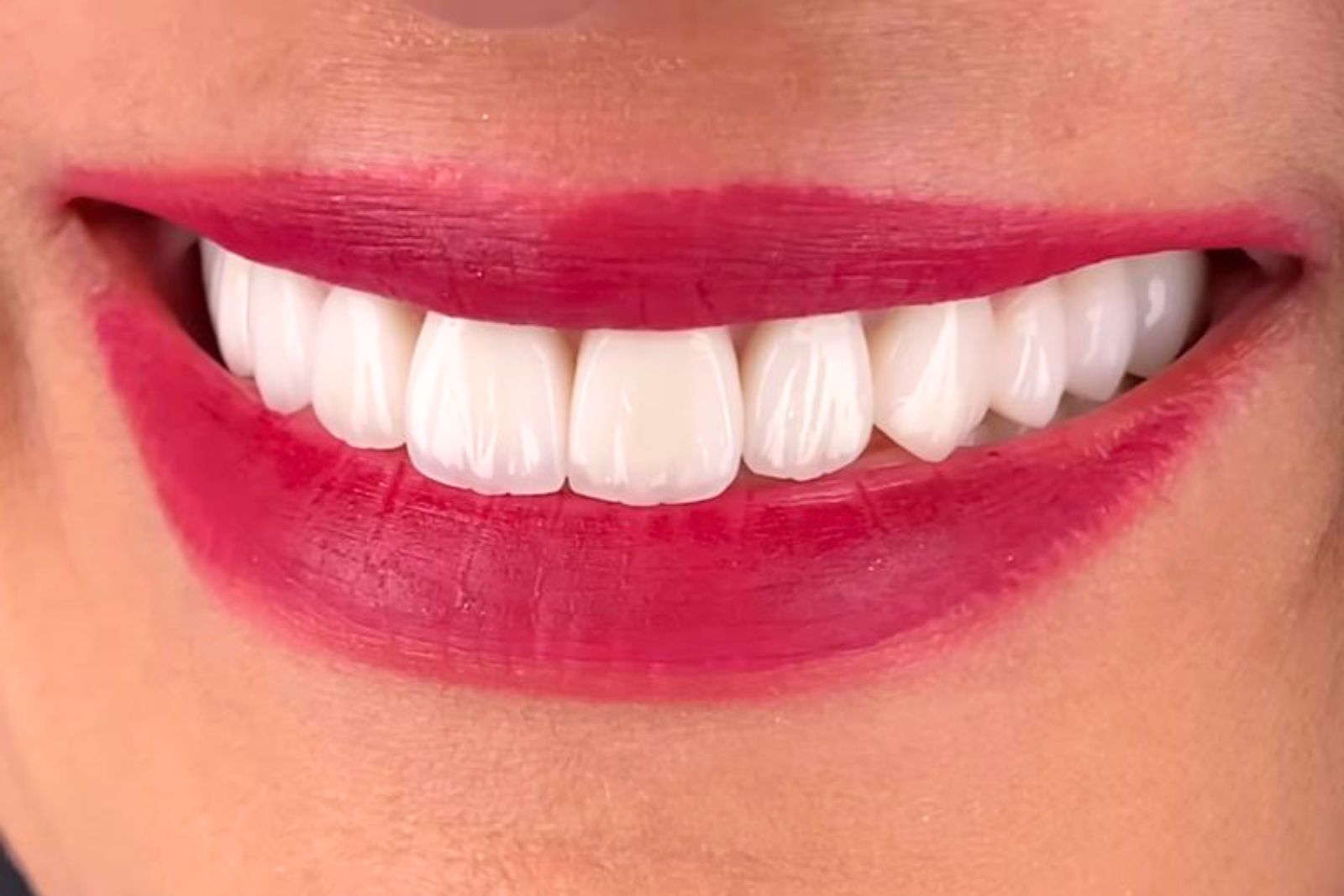 Teeth Whitening in Dubai
