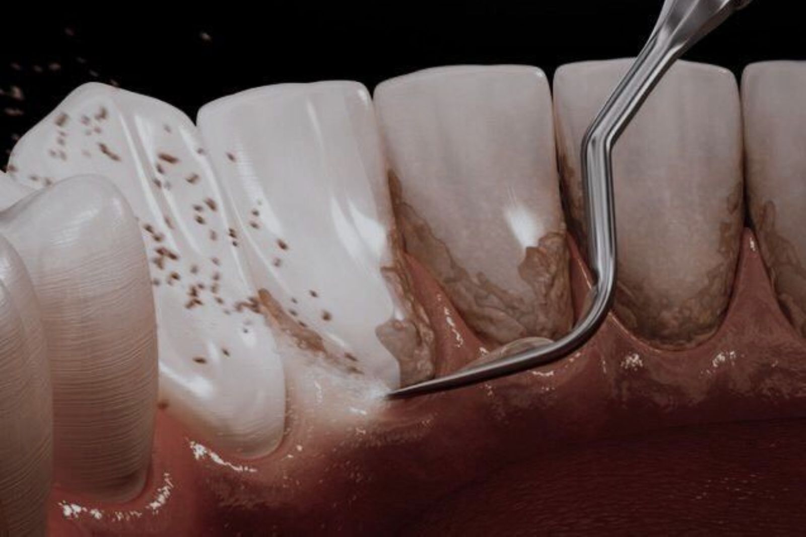 Scaling & Polishing in Dubai
